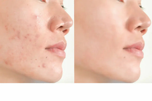 💧K-Beauty & the Skin Barrier: The Secret to Strong, Glowing Skin